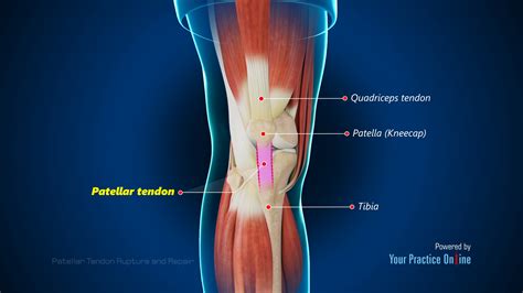 torn patellar tendon symptoms